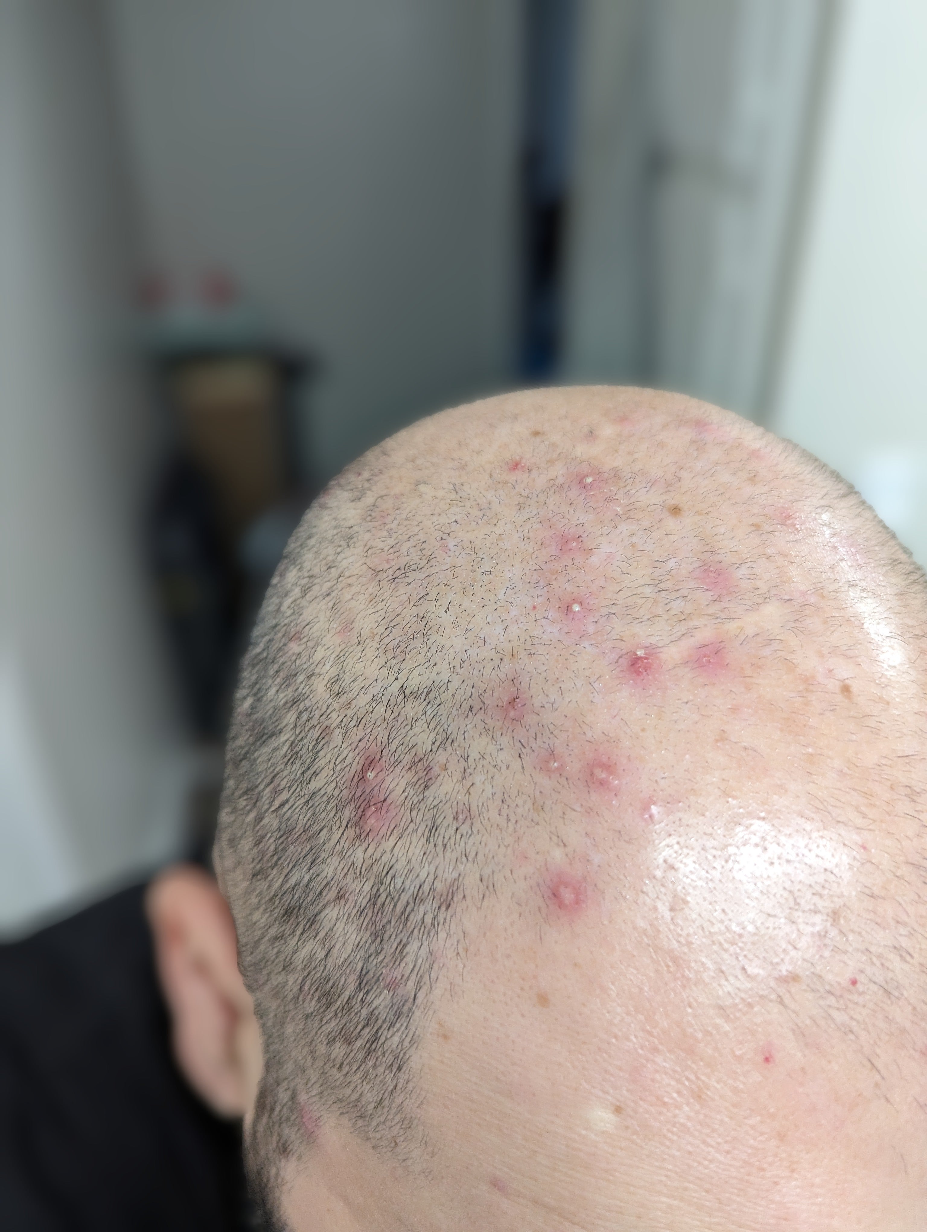 Before using Samu's Bee and Flow manuka scalp right