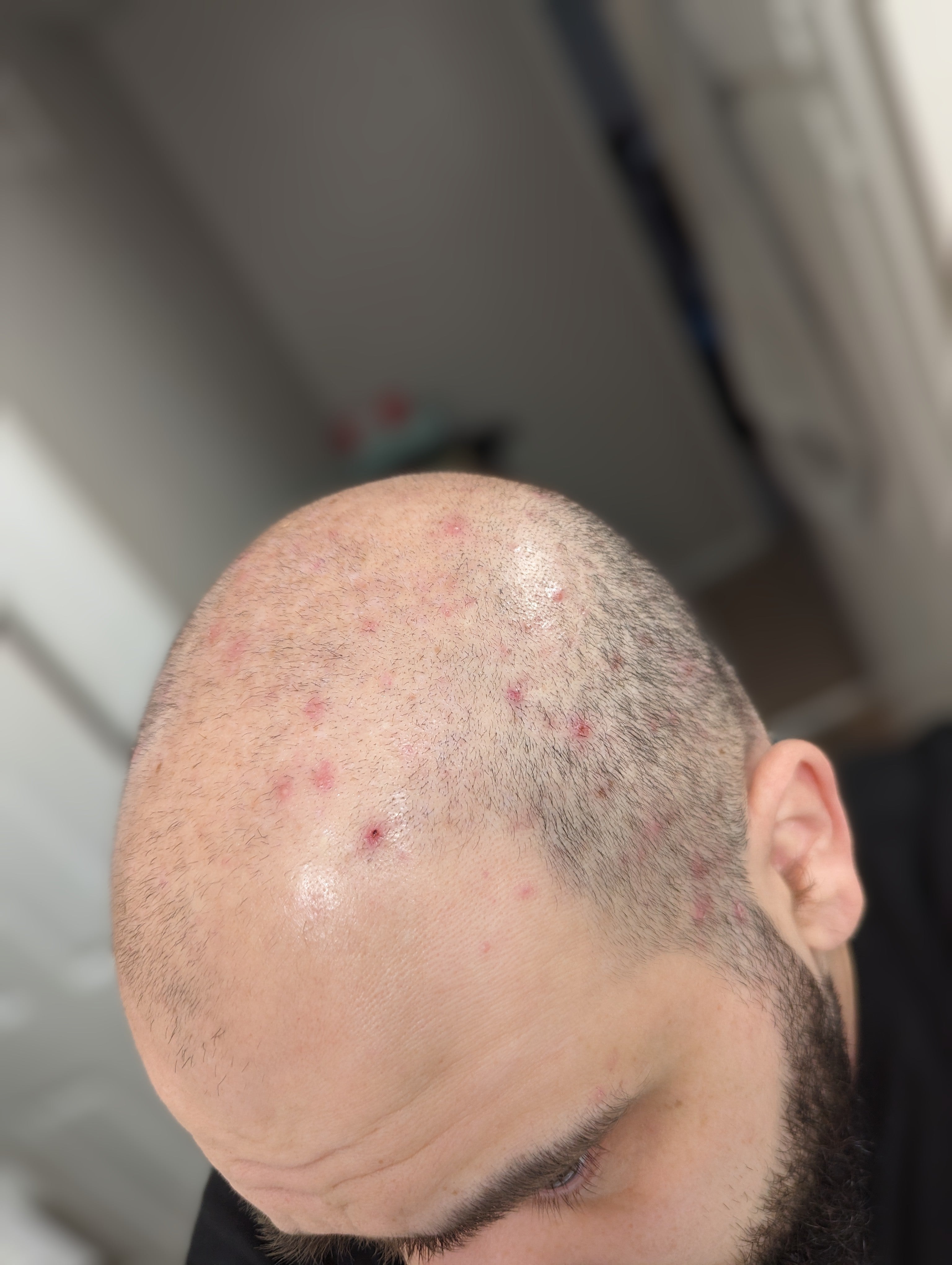 Before using Samu's Bee and Flow manuka scalp left