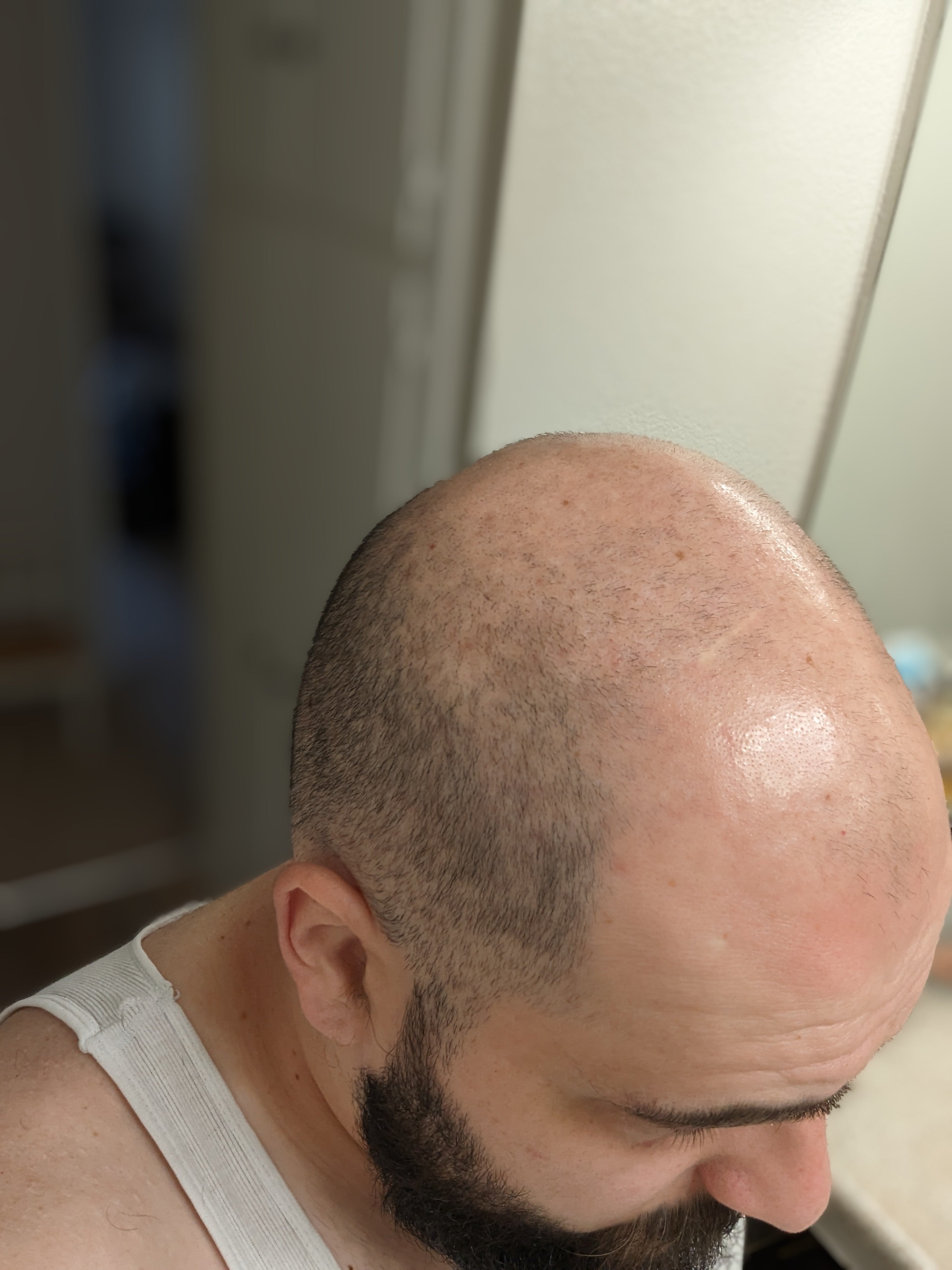 After using Samu's Bee and Flow manuka scalp right